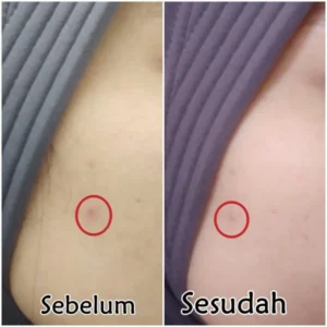 review acne serum scarlett